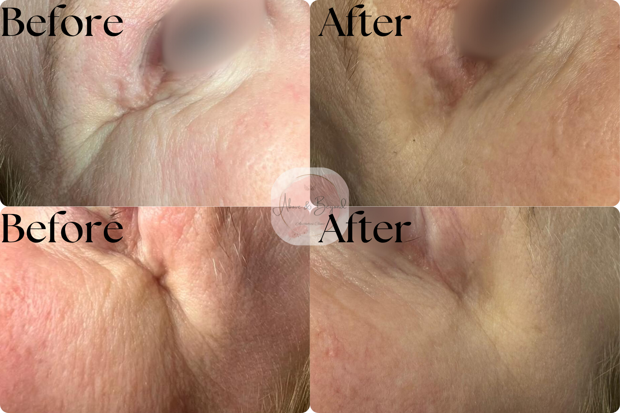 Anti-Wrinkle Treatment