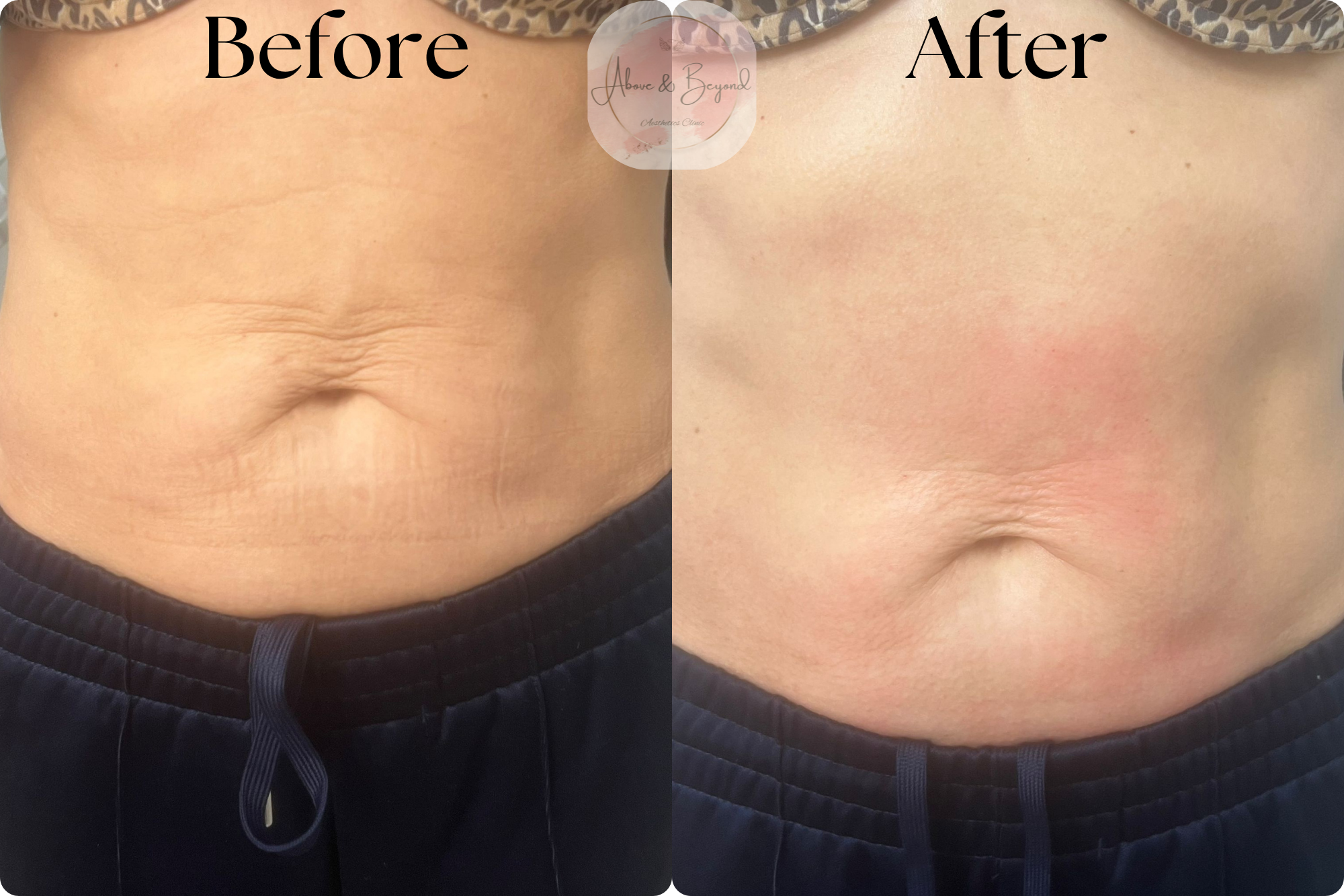 Bespoke Body Treatment